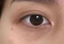 30岁后面部[水土流失]！颧骨锋利+太阳穴漏斗，抗衰焊年轻态