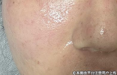 水光注射联合氨甲环酸：开启肌肤焕颜新征程