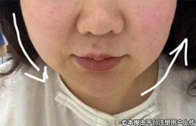 揭秘术后线头外露：成因与应对之策