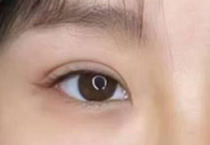 审美霸权下的双眼皮符号：总为双眼皮焦虑怎么办