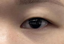 多数人陷入选择困境：如何判断自己适合哪种双眼皮形态