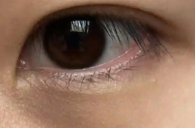 色素型黑眼圈怎么改善？-49642