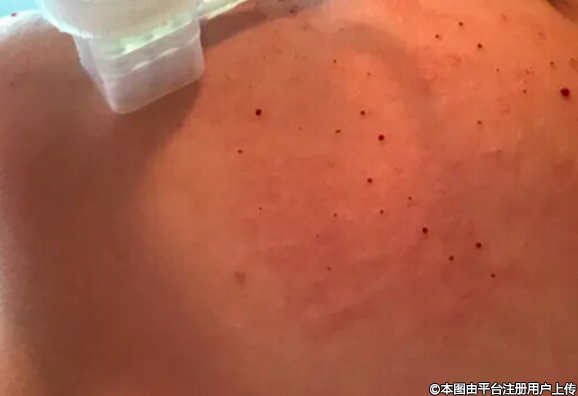 干皮但是毛孔也很大的人能不能做？