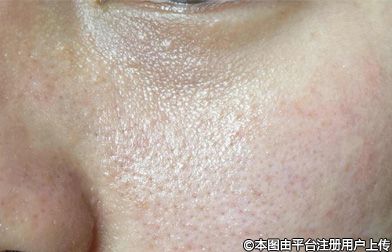 黄金射频微针与热玛吉：技术原理与功效的深度解析