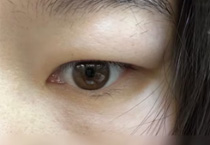 肿泡眼能做双眼皮吗？手残党必看！3个救命细节决定成败