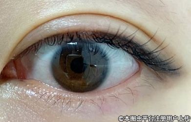 眼部整形：雕琢明眸之美，重塑眼部魅力