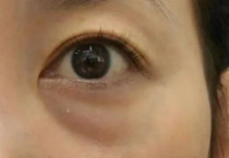 初老先看眼！泪沟眼袋自救指南