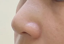 不放假体do鼻是新的隆鼻方式吗
