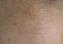 斑点别只打超皮秒！3招联合治疗，效果翻倍避坑指南