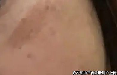 做激光祛斑应选择皮秒激光祛斑的五大理由