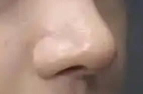耳软骨隆鼻多久才能完全消肿