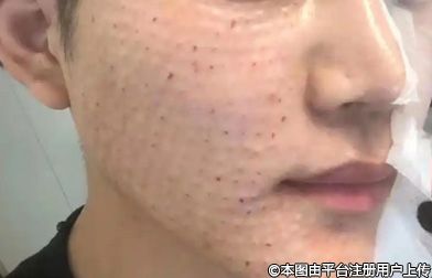你知道你的毛孔为什么粗大吗？