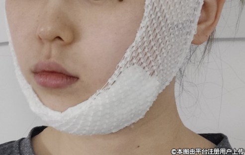 自体脂肪填充术后饮食要注意什么？