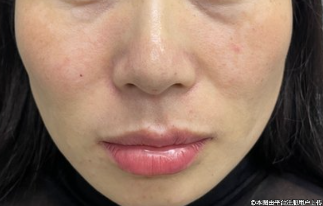 瘦姑娘慎选自体脂肪移植：解析身体条件与手术风险的深层关联