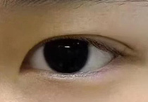 双眼皮手术怎么判断自己需不需要提肌