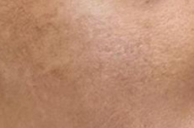 一年积累下来的皮肤暗淡松弛 如何选择变美方式-49966