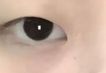 内双可以做哪种双眼皮手
