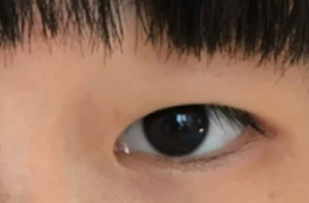 双眼皮术后是否有必要进行用力睁眼闭眼练习