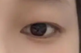 到底什么季节适合做双眼皮手术呢