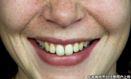 去除法令纹，项目如何选择？-50005