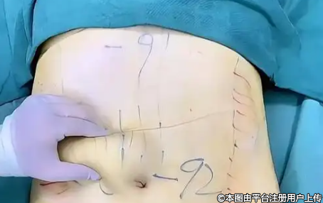 解锁身体轻盈密码：深入认识吸脂手术