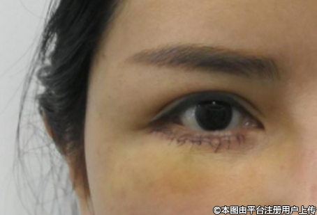 自体脂肪填充泪沟：疗程次数与术后护理全解析