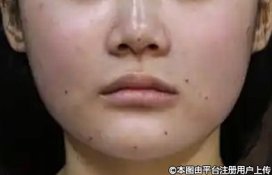 面部下垂应对指南：科学抗衰，重焕青春光彩