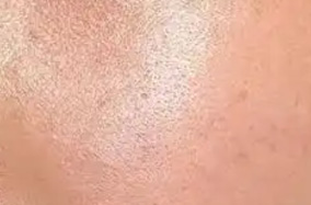 30+岁肤色暗沉急救指南：科学医美破解灰黄雾蒙感