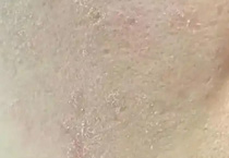 夏季肌肤危机与逆袭秘籍：解锁高温环境下的医美焕肤黄金方案