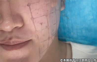 哪些人适合做热玛吉？全面解析适用人群与禁忌