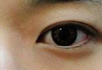 夏季双眼皮手术量激增，学生与都市白领成主力人群