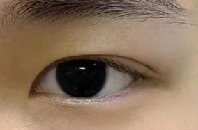 暑期双眼皮蜕变季：自然妈生眼/多元眼型黄金期变美指南-50141