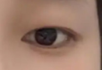 学生党必看！高考后双眼皮整形全攻略，假期悄悄变美