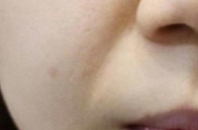 今天的你护肤了吗？激光美容术帮你解决肌肤问题哦-50201