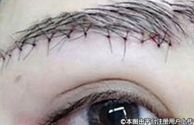 提眉与双眼皮：如何选择？