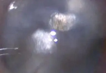 白内障手术如何选择人工晶状体？-50225