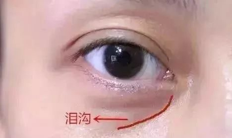 泪沟填充术前注意事项全解析