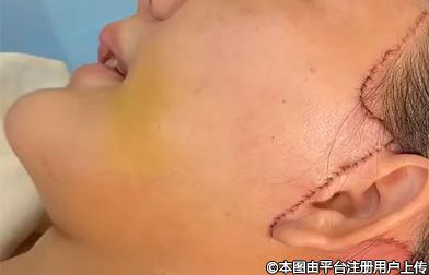 面部松弛下垂——面部提升治疗方式不同