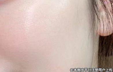 做完光子嫩肤后会爆痘，这是真的吗？