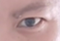 高考生摘镜近视激光手术方式如何选择