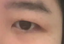 单眼皮内眦总被误认是斗鸡眼？解决方案来了