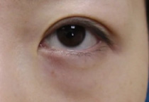 祛眼袋后直播状态封神！原来告别老态眼有这些捷径
