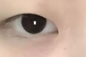 双眼皮术后黄金恢复期！这些要点必须掌握