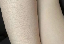 现代审美催生体毛焦虑，医美技术提供解决方案