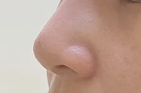 隆鼻不想放假体，无假体隆鼻VS玻尿酸隆鼻，哪种适合您-50339