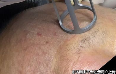 点阵激光术后红肿应对指南