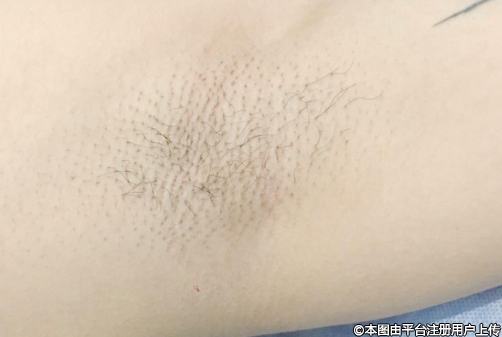 激光脱毛什么时候做比较好？全方位解析与建议