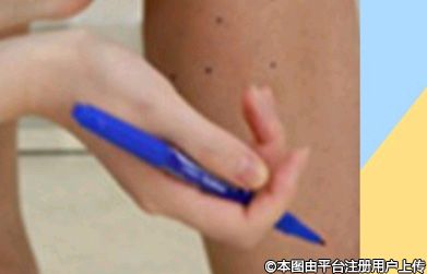 夏天能否做注射瘦腿项目？全方位解析来啦