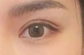 双眼皮割多宽才合适？双眼皮的宽度到底该怎么选择
