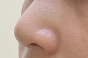 自体肋软骨隆鼻，你不知道的那些事